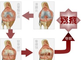 结缔组织病是风湿还是类风湿(结缔组织病算不算大病)