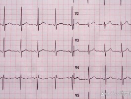 心律失常严重吗(室性心律失常严重吗)