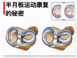 半月板(半月板撕裂怎么治疗最好)