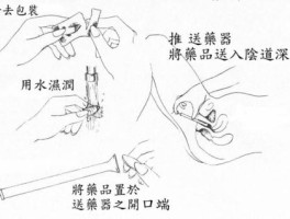 栓剂的正确使用方法(妇科栓剂的正确使用方法)