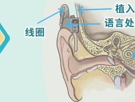 人工耳蜗与助听器的区别在哪(三种人不能戴助听器)