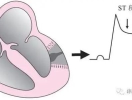 心梗的前兆有哪些症状(心梗的前兆有哪些症状吃什么药)